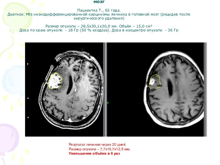 Пример радиохирургического лечения одиночного метастаза в головной мозг Пациентка Т.,