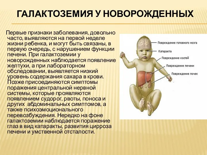 ГАЛАКТОЗЕМИЯ У НОВОРОЖДЕННЫХ Первые признаки заболевания, довольно часто, выявляются на