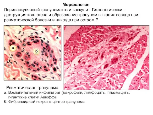Ревматическая гранулема а. Воспалительный инфильтрат (макрофаги, лимфоциты, плазмациты, гигантские клетки Ашоффа; б. Фибриноидный