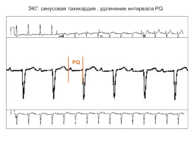 ЭКГ: синусовая тахикардия , удлинение интервала PQ
