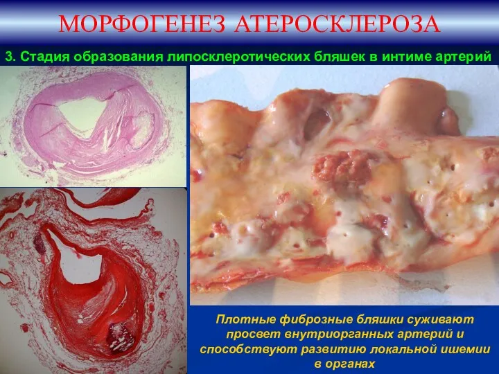 МОРФОГЕНЕЗ АТЕРОСКЛЕРОЗА 3. Стадия образования липосклеротических бляшек в интиме артерий