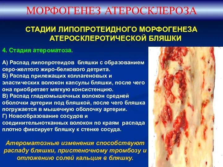 СТАДИИ ЛИПОПРОТЕИДНОГО МОРФОГЕНЕЗА АТЕРОСКЛЕРОТИЧЕСКОЙ БЛЯШКИ МОРФОГЕНЕЗ АТЕРОСКЛЕРОЗА 4. Стадия атероматоза.