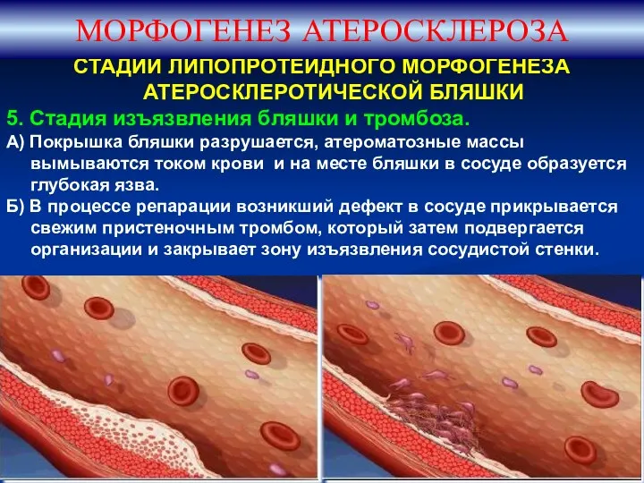 СТАДИИ ЛИПОПРОТЕИДНОГО МОРФОГЕНЕЗА АТЕРОСКЛЕРОТИЧЕСКОЙ БЛЯШКИ 5. Стадия изъязвления бляшки и