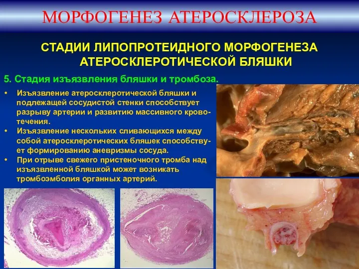 СТАДИИ ЛИПОПРОТЕИДНОГО МОРФОГЕНЕЗА АТЕРОСКЛЕРОТИЧЕСКОЙ БЛЯШКИ 5. Стадия изъязвления бляшки и