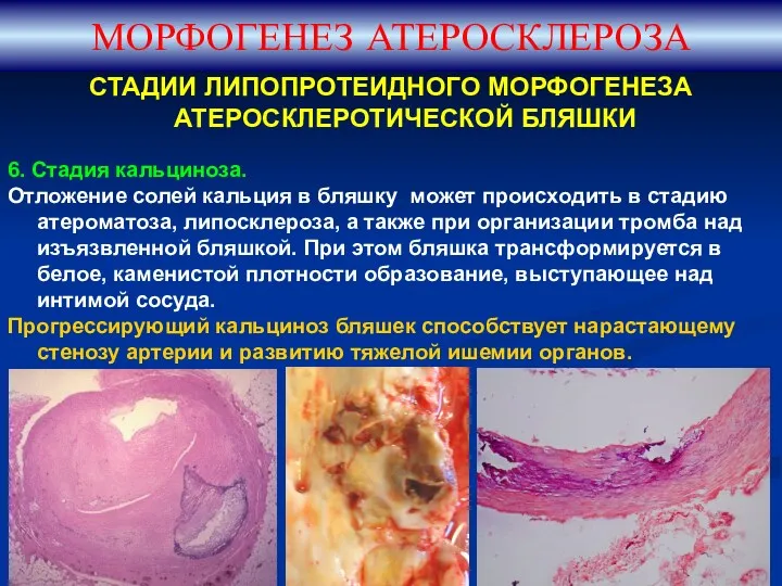 СТАДИИ ЛИПОПРОТЕИДНОГО МОРФОГЕНЕЗА АТЕРОСКЛЕРОТИЧЕСКОЙ БЛЯШКИ 6. Стадия кальциноза. Отложение солей