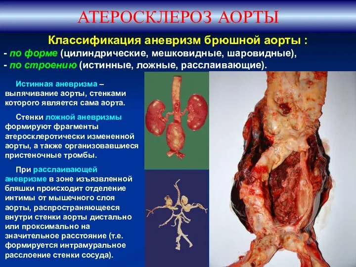 АТЕРОСКЛЕРОЗ АОРТЫ Классификация аневризм брюшной аорты : - по форме