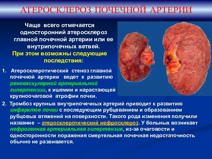 АТЕРОСКЛЕРОЗ ПОЧЕЧНОЙ АРТЕРИИ Чаще всего отмечается односторонний атеросклероз главной почечной