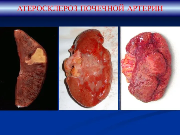 АТЕРОСКЛЕРОЗ ПОЧЕЧНОЙ АРТЕРИИ