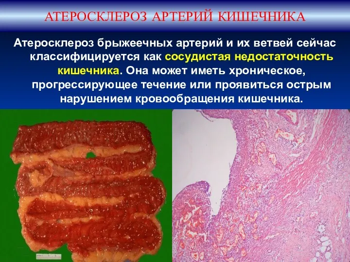АТЕРОСКЛЕРОЗ АРТЕРИЙ КИШЕЧНИКА Атеросклероз брыжеечных артерий и их ветвей сейчас