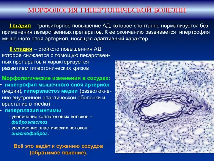 МОРФОЛОГИЯ ГИПЕРТОНИЧЕСКОЙ БОЛЕЗНИ I стадия – транзиторное повышение АД, которое