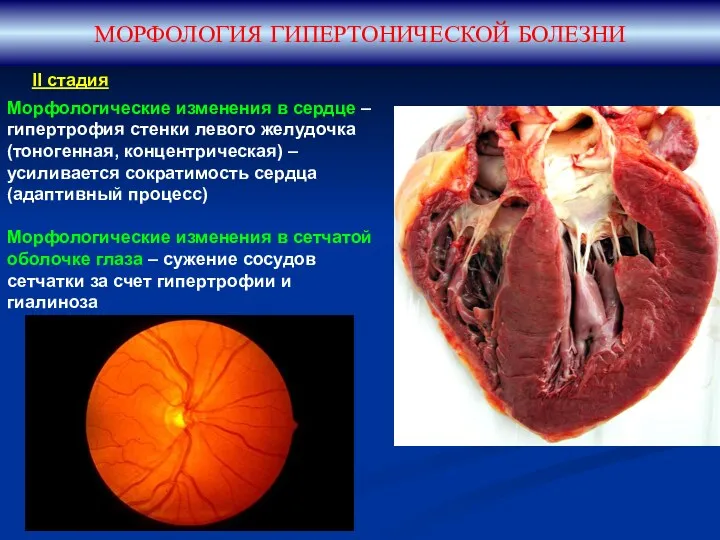 МОРФОЛОГИЯ ГИПЕРТОНИЧЕСКОЙ БОЛЕЗНИ II стадия Морфологические изменения в сердце –