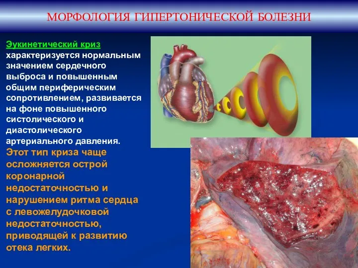 МОРФОЛОГИЯ ГИПЕРТОНИЧЕСКОЙ БОЛЕЗНИ Эукинетический криз характеризуется нормальным значением сердечного выброса