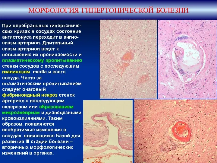 МОРФОЛОГИЯ ГИПЕРТОНИЧЕСКОЙ БОЛЕЗНИ При церебральных гипертониче-ских кризах в сосудах состояние
