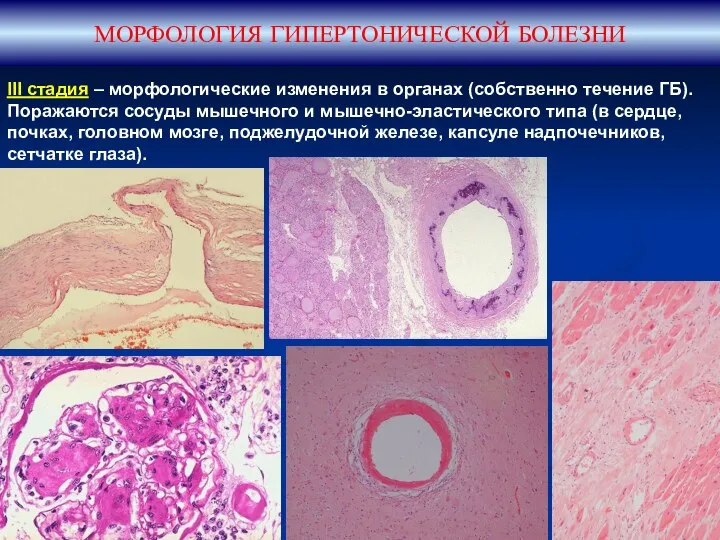 МОРФОЛОГИЯ ГИПЕРТОНИЧЕСКОЙ БОЛЕЗНИ III стадия – морфологические изменения в органах