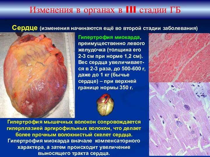 Изменения в органах в III стадии ГБ Сердце (изменения начинаются