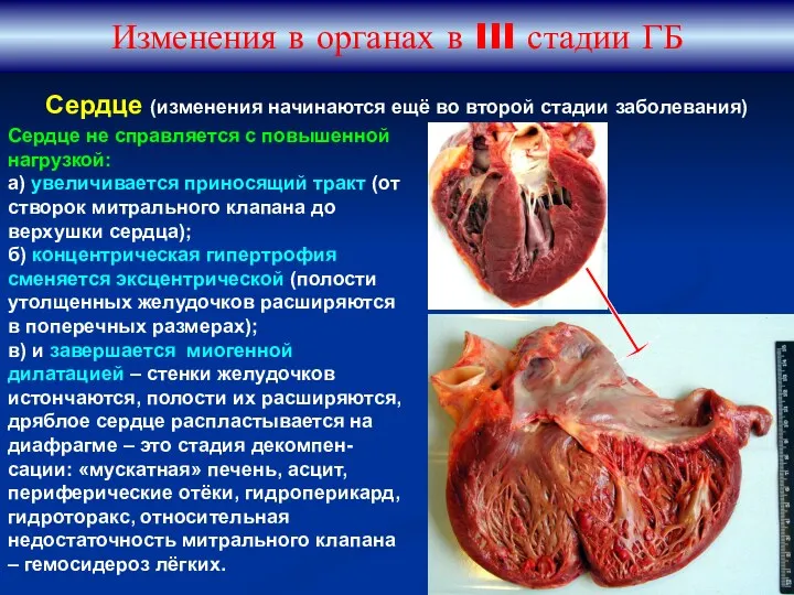 Изменения в органах в III стадии ГБ Сердце не справляется