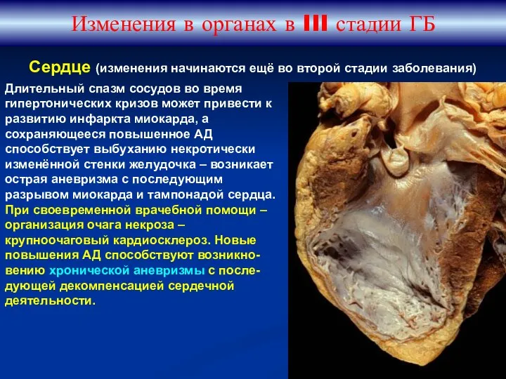 Изменения в органах в III стадии ГБ Длительный спазм сосудов