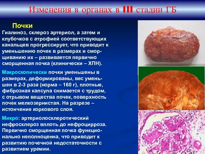 Изменения в органах в III стадии ГБ Гиалиноз, склероз артериол,