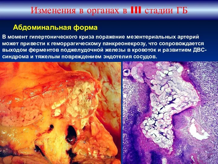 Изменения в органах в III стадии ГБ В момент гипертонического