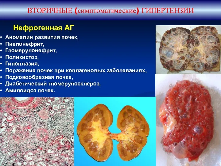 ВТОРИЧНЫЕ (симптоматические) ГИПЕРТЕНЗИИ Аномалии развития почек, Пиелонефрит, Гломерулонефрит, Поликистоз, Гипоплазия,