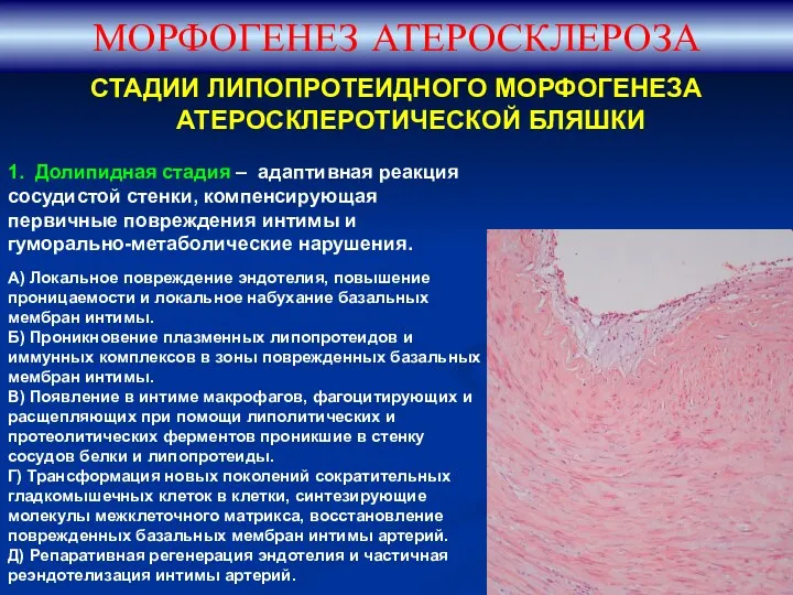 СТАДИИ ЛИПОПРОТЕИДНОГО МОРФОГЕНЕЗА АТЕРОСКЛЕРОТИЧЕСКОЙ БЛЯШКИ МОРФОГЕНЕЗ АТЕРОСКЛЕРОЗА 1. Долипидная стадия