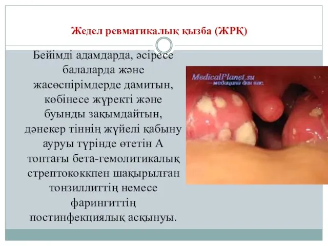 Жедел ревматикалық қызба (ЖРҚ) Бейімді адамдарда, әсіресе балаларда және жасөспірімдерде