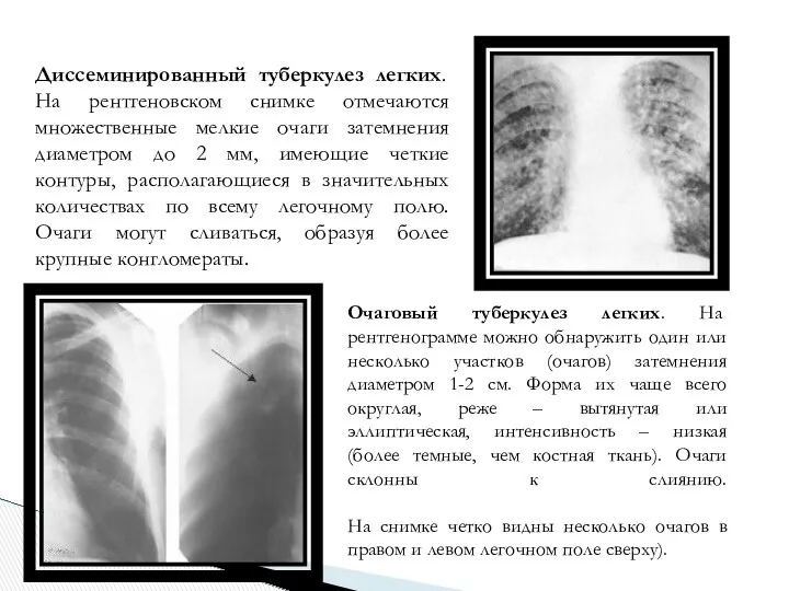 Диссеминированный туберкулез легких. На рентгеновском снимке отмечаются множественные мелкие очаги затемнения диаметром до