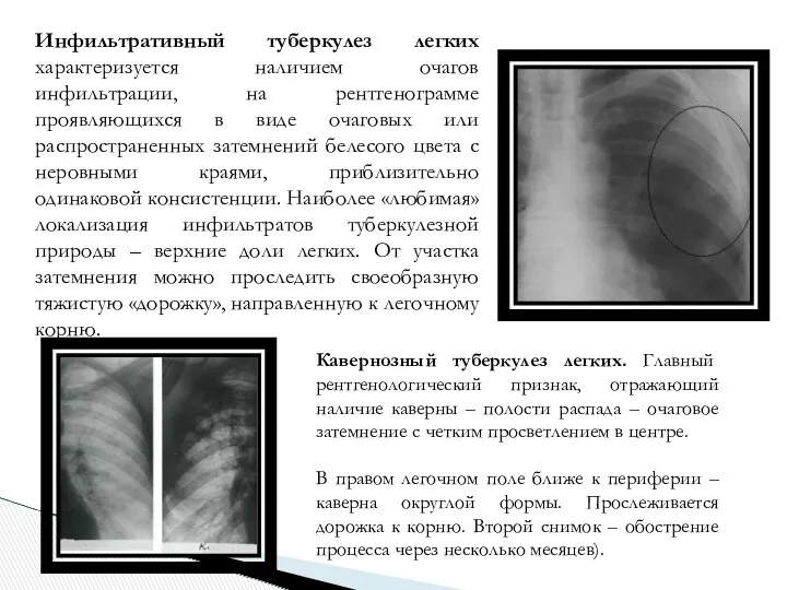 Инфильтративный туберкулез легких характеризуется наличием очагов инфильтрации, на рентгенограмме проявляющихся в виде очаговых