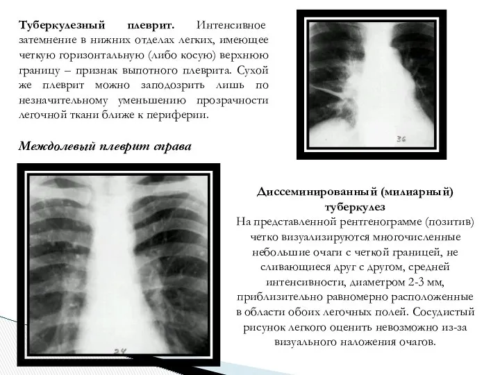 Туберкулезный плеврит. Интенсивное затемнение в нижних отделах легких, имеющее четкую горизонтальную (либо косую)