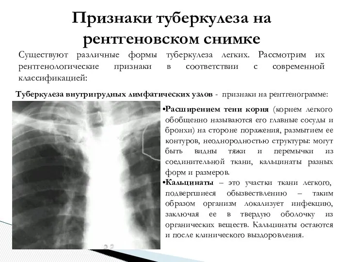 Признаки туберкулеза на рентгеновском снимке Существуют различные формы туберкулеза легких. Рассмотрим их рентгенологические
