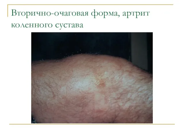 Вторично-очаговая форма, артрит коленного сустава