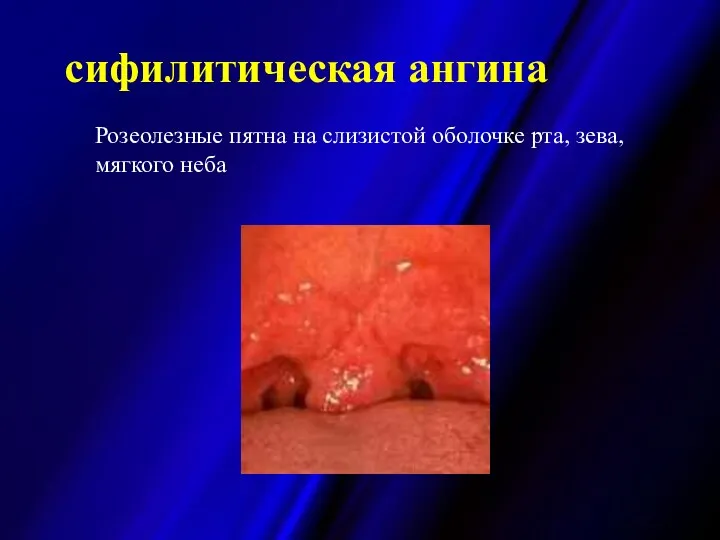 сифилитическая ангина Розеолезные пятна на слизистой оболочке рта, зева, мягкого неба