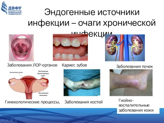 Эндогенные источники инфекции – очаги хронической инфекции Заболевания ЛОР-органов Кариес зубов Заболевания почек