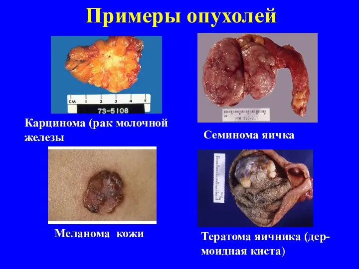 Примеры опухолей Карцинома (рак молочной железы Семинома яичка Меланома кожи Тератома яичника (дер- моидная киста)
