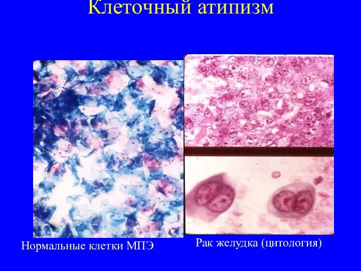 Клеточный атипизм Нормальные клетки МПЭ Рак желудка (цитология)