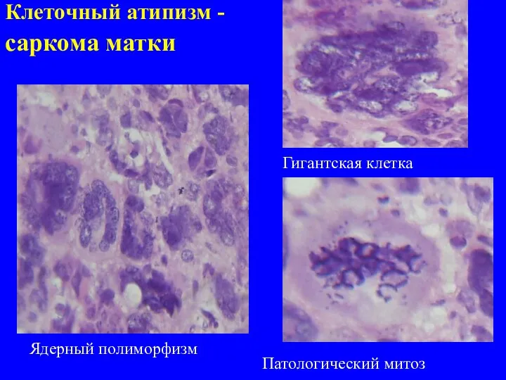 Клеточный атипизм - саркома матки Ядерный полиморфизм Гигантская клетка Патологический митоз