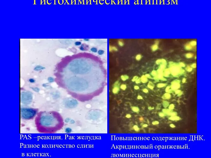 Гистохимический атипизм PAS –реакция. Рак желудка Разное количество слизи в клетках. Повышенное содержание