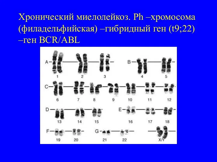 Хронический миелолейкоз. Ph –хромосома (филадельфийская) –гибридный ген (t9;22) –ген BCR/ABL