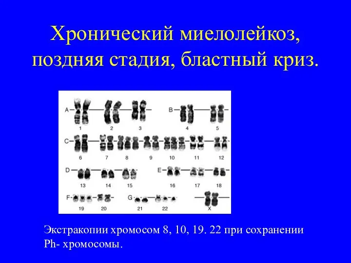 Хронический миелолейкоз, поздняя стадия, бластный криз. Экстракопии хромосом 8, 10, 19. 22 при сохранении Ph- хромосомы.