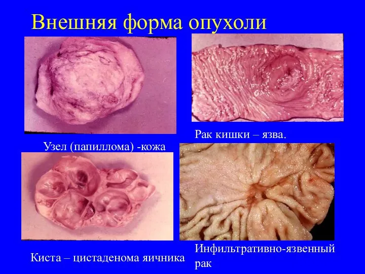 Внешняя форма опухоли Узел (папиллома) -кожа Рак кишки – язва. Киста – цистаденома яичника Инфильтративно-язвенный рак