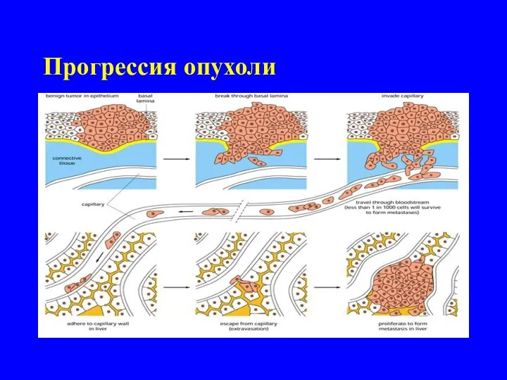 Прогрессия опухоли