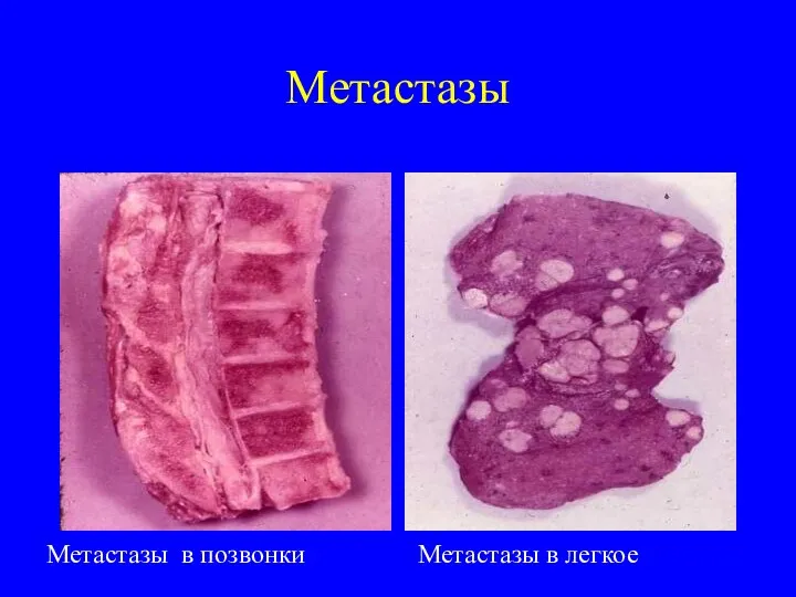 Метастазы Метастазы в позвонки Метастазы в легкое