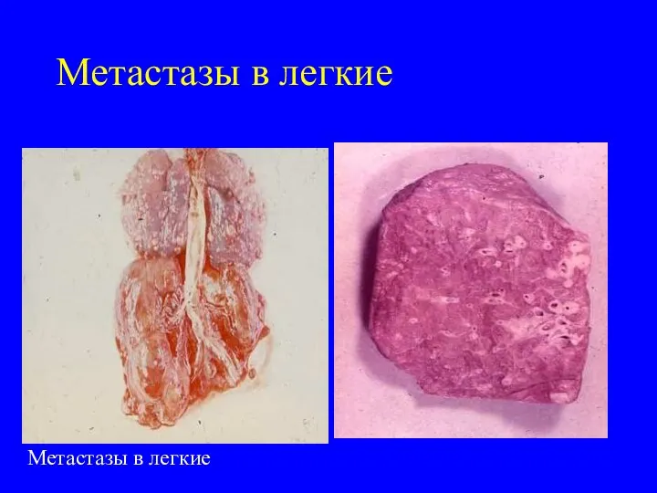 Метастазы в легкие Метастазы в легкие