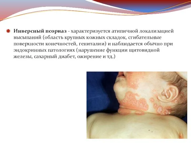 Инверсный псориаз - характеризуется атипичной локализацией высыпаний (область крупных кожных