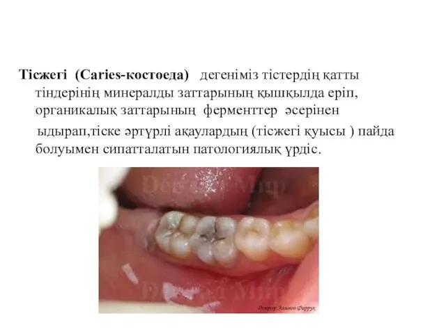 Тісжегі (Caries-костоеда) дегеніміз тістердің қатты тіндерінің минералды заттарының қышқылда еріп,органикалық