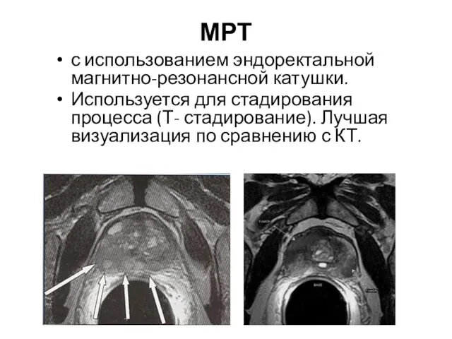 МРТ с использованием эндоректальной магнитно-резонансной катушки. Используется для стадирования процесса (Т- стадирование). Лучшая