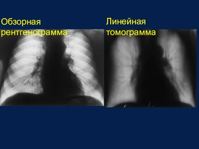 Обзорная рентгенограмма Линейная томограмма