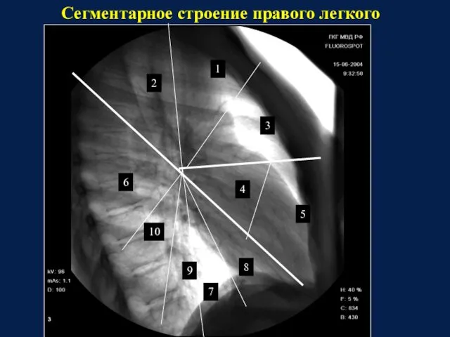 1 1 10 9 7 8 5 4 3 1 2 6 Сегментарное строение правого легкого