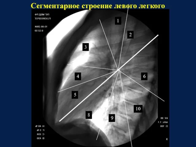 8 9 10 6 5 4 3 1 2 Сегментарное строение левого легкого