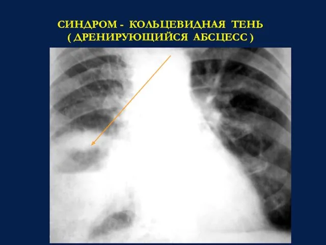 СИНДРОМ - КОЛЬЦЕВИДНАЯ ТЕНЬ ( ДРЕНИРУЮЩИЙСЯ АБСЦЕСС )